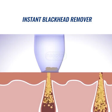 4 In 1 Multi-Function Blackhead Remover (BHR3)