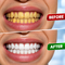 Purple Teeth Whitening Gel