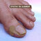 Toenail Corrector Patch Pack of 20 (FCR2)